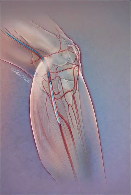 Below The Ankle Tapered Balloon For PAD